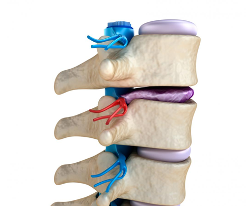 Degenerative Disc Disease