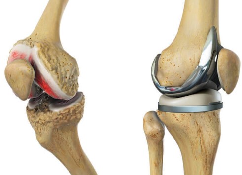 knee replacement hospital